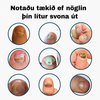 Blá ljósmeðferð við naglasveppi heima